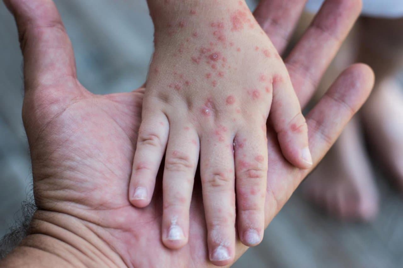 ANSP: Rata de vaccinare anti-rujeolă scade sub pragul de siguranță