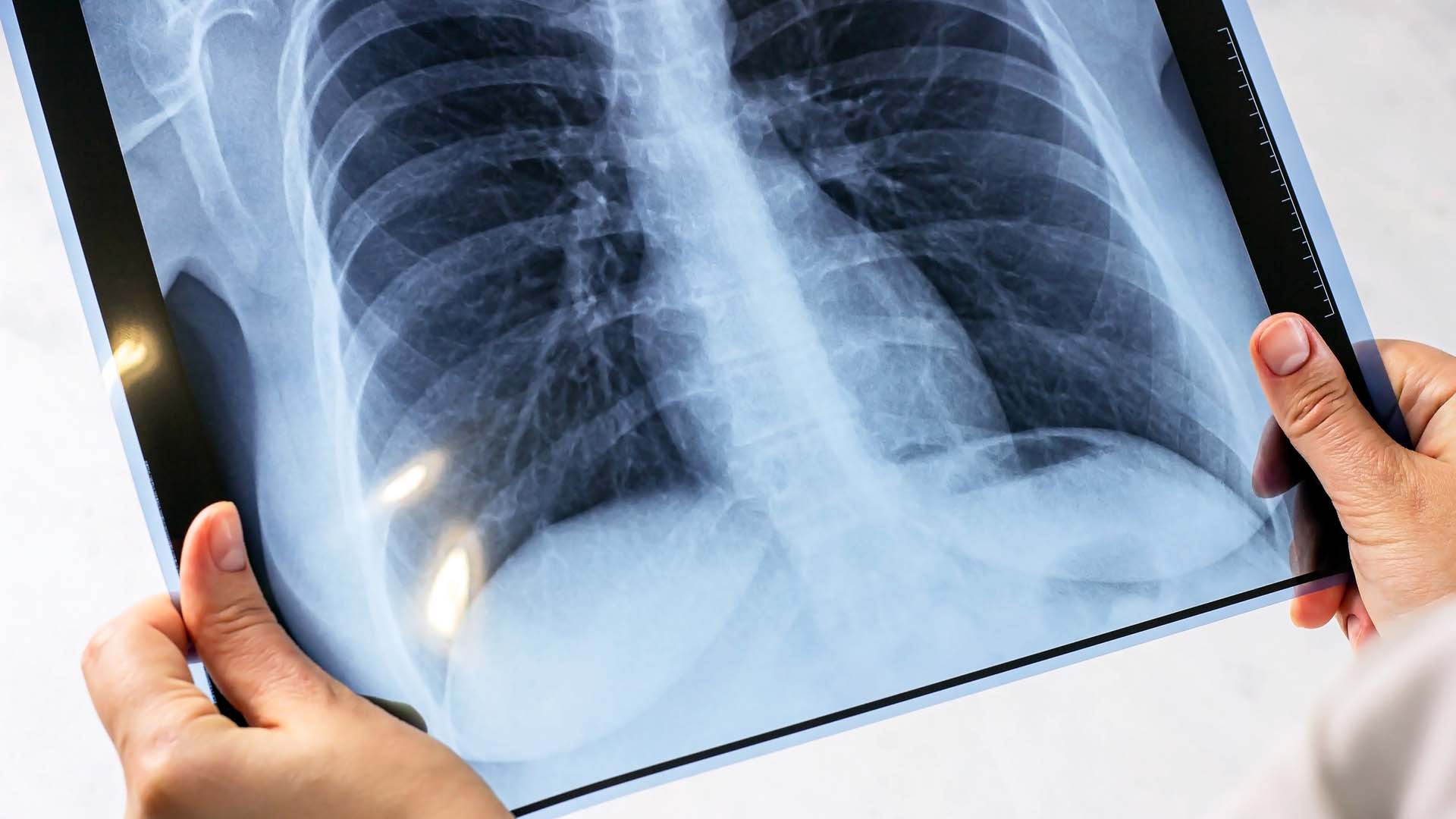 Tuberculoza afectează sute de moldoveni. Progrese în tratament, dar persistă formele rezistente
